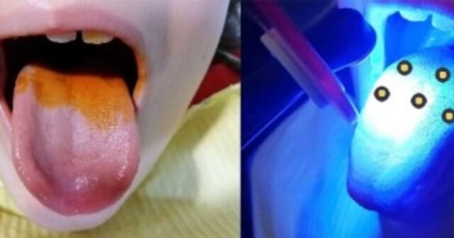 Annatto and LED therapy fight bad breath in children, study finds.